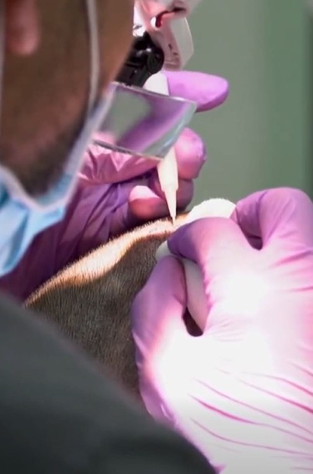 Hair restoration at Clinique de Paris